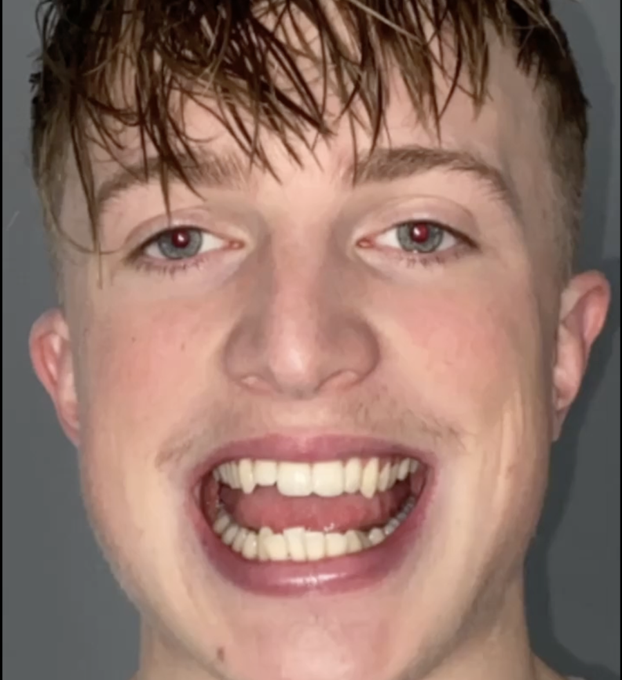 6 month braces - before - 3dental - Sean Fitz